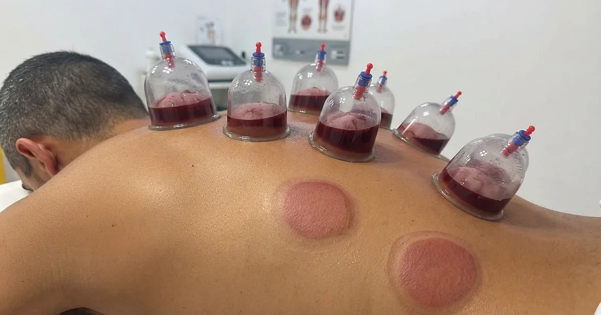 La hijama : origines, bienfaits et indications